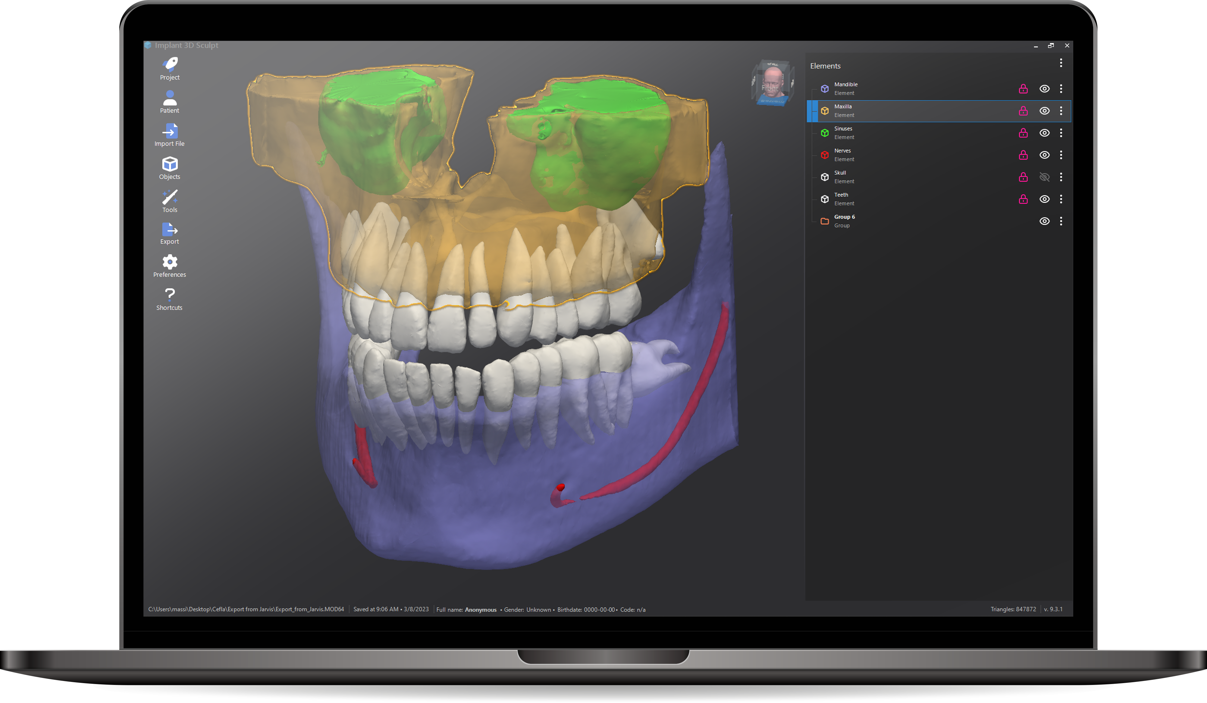 Implant 3D software interface on laptop