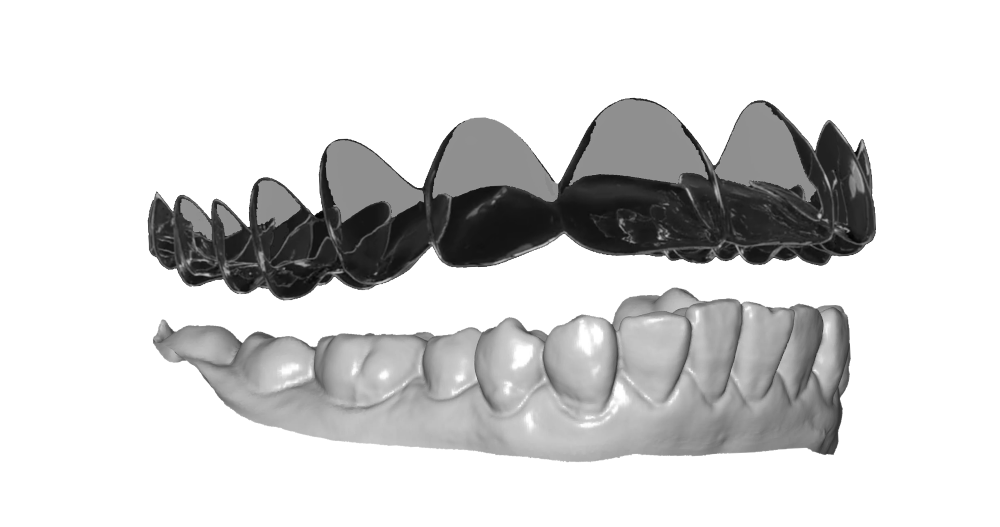 ORTH’UP clear-aligner CAD interface