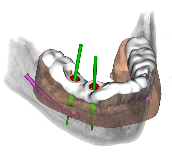 PlastyCAD planning illustration