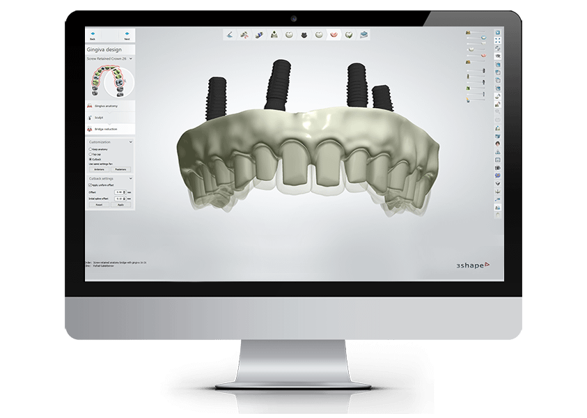 Official 3Shape Dental System screen showing implant-supported gingiva design